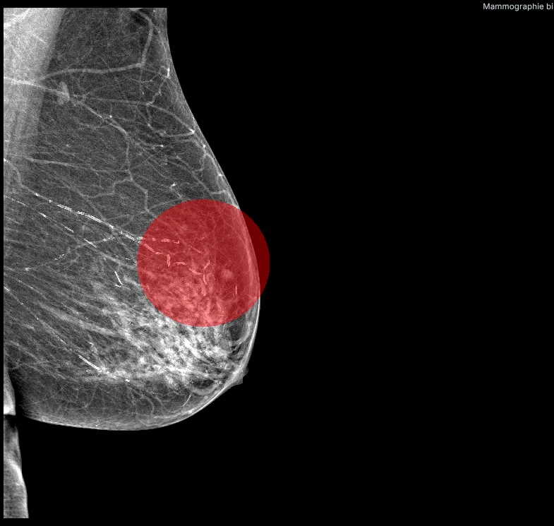 Mammographie avec superposition d'un r&eacute;sultat d'IA