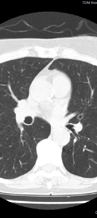 Scanner thoracique en fen&ecirc;tre pulmonaire